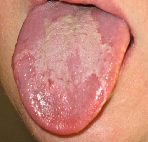 LENGUA GEOGRAFICA/GLOSITIS MIGRATORIA BENINGNA