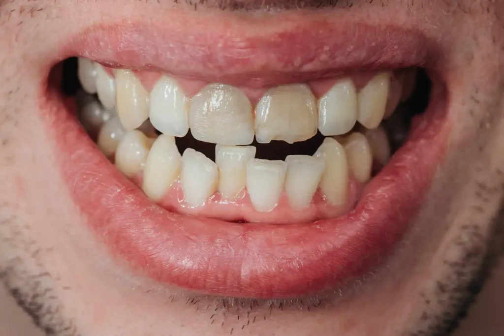 apiñamiento dental-3