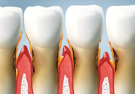 sensibilidad-dental-dentina.