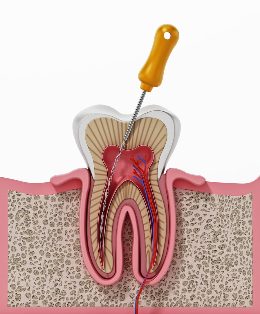 reconstruccion-de-muela-tras-endodoncia-sjd-dentistas