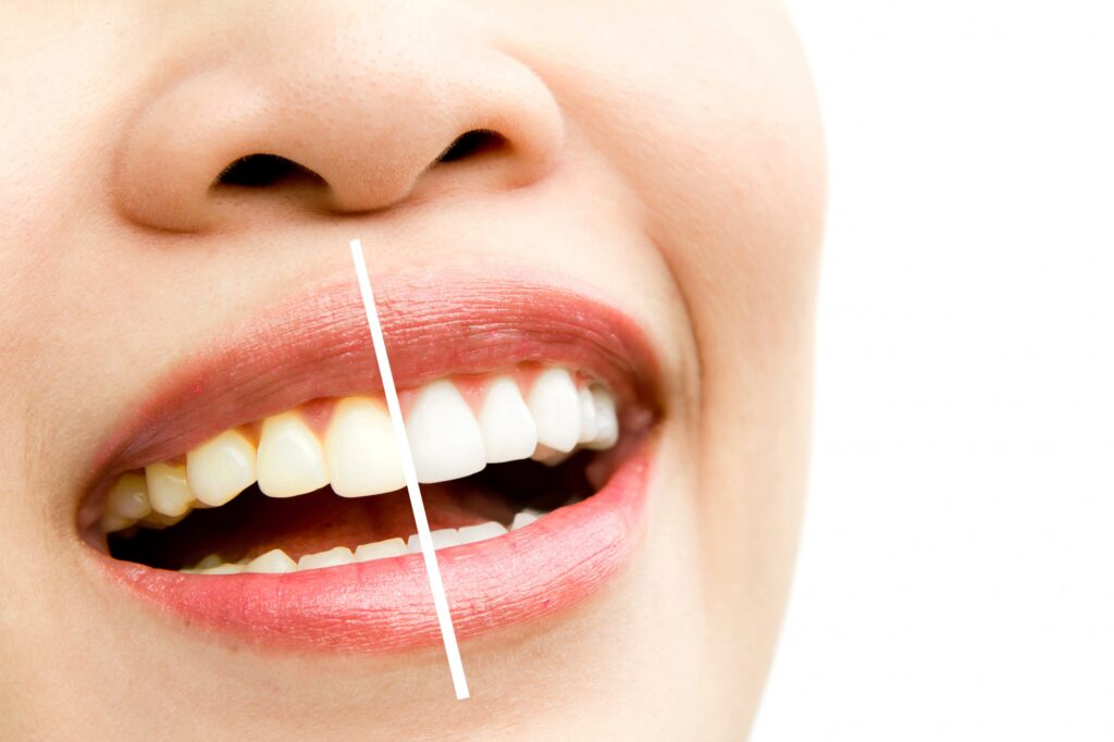 tooth whitening in tenerife - comparison