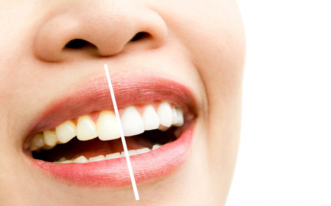 tooth whitening in tenerife - comparison