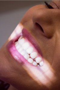 tooth whitening in tenerife - light