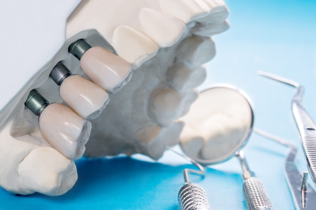 Implantes-dentales-en-Tenerife-boca