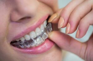 Clínicas dentales en Tenerife - invisalign sonrisa