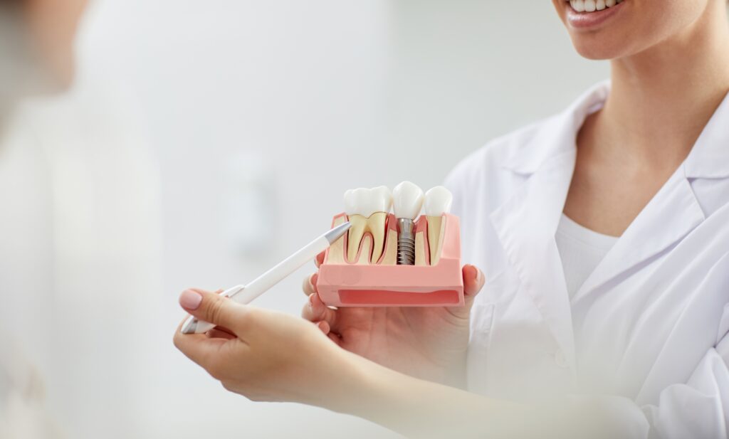 Prosthesis on implants in Tenerife shown on a dental model during clinical assessment