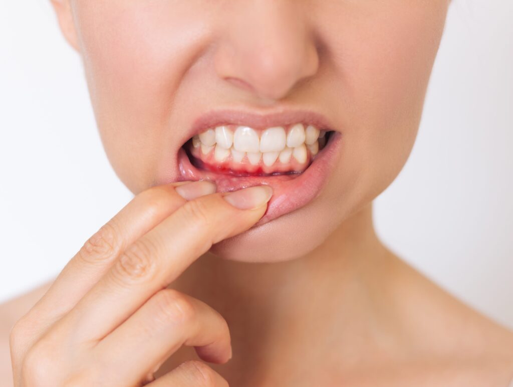 periodoncia en tenerife - gingivitis