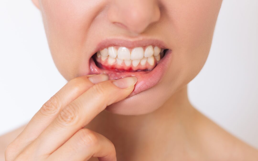 periodoncia en tenerife - gingivitis