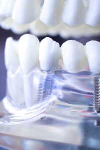 implantologia dental en tenerife - boca artificial