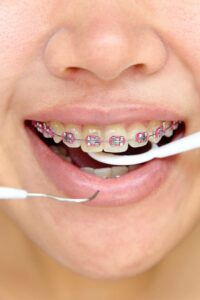 orthodontic in tenerife - colours